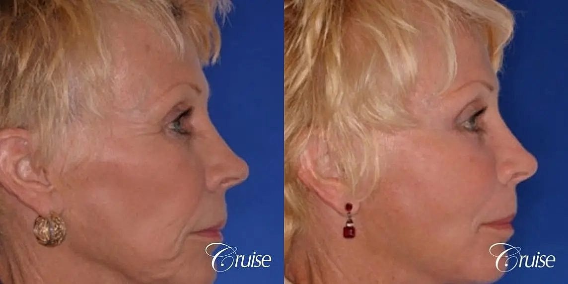 Brow Lift Before & After