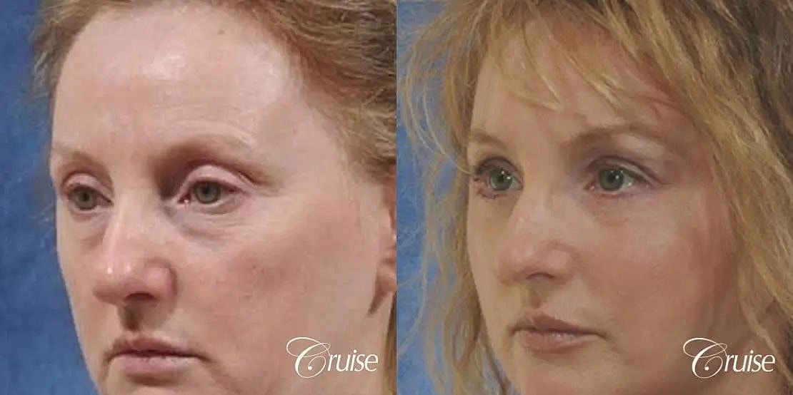 Brow Lift Before & After