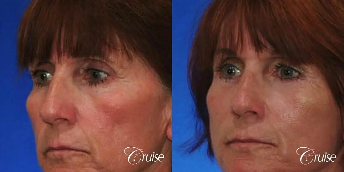 Brow Lift Before & After