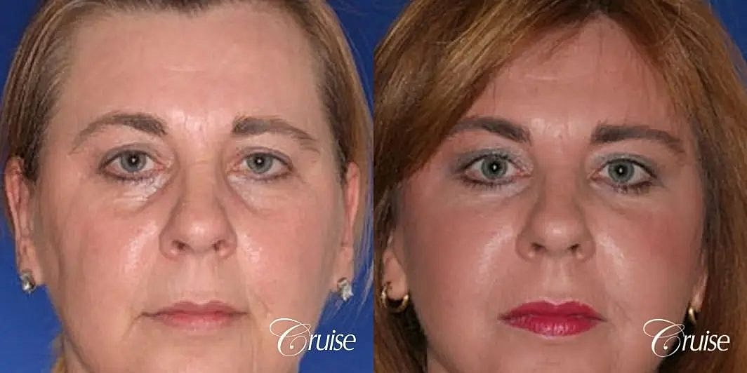 Brow Lift Before & After