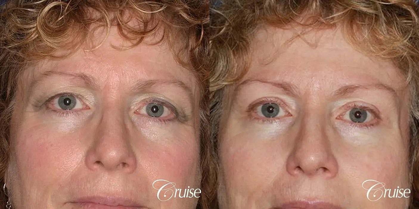 Brow Lift Before & After