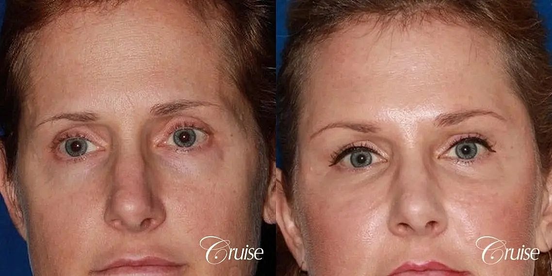 Brow Lift Before & After