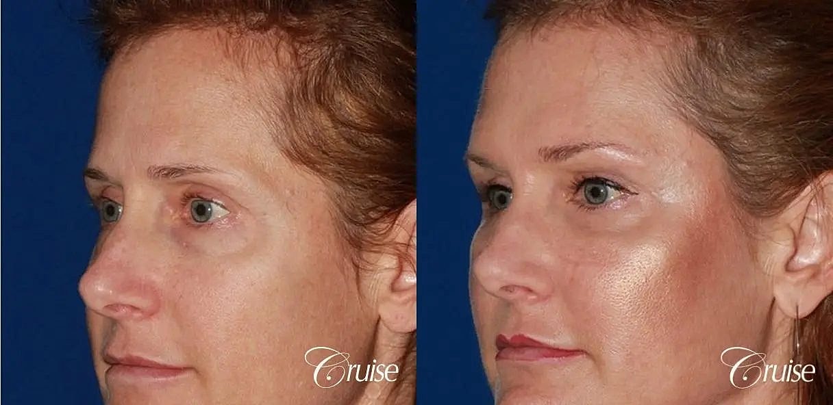 Brow Lift Before & After