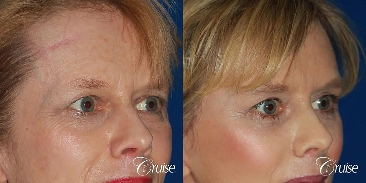 Brow Lift Before & After