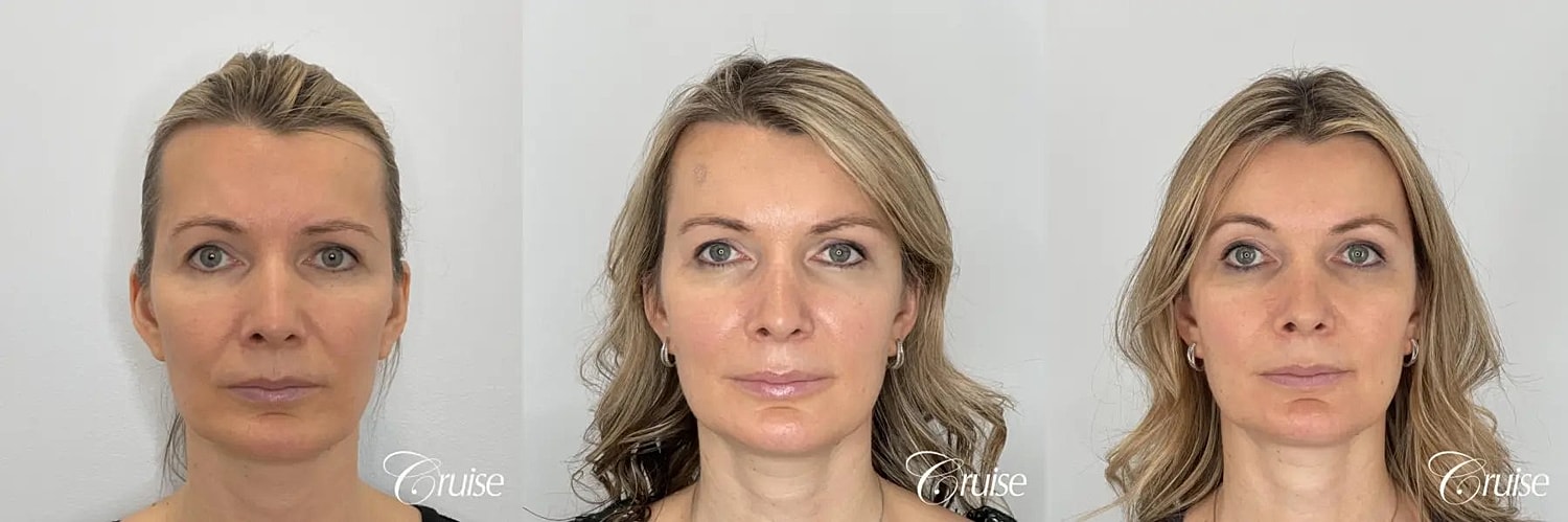 Brow Lift Before & After