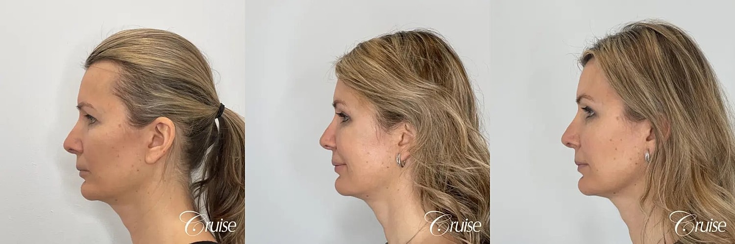 Brow Lift Before & After