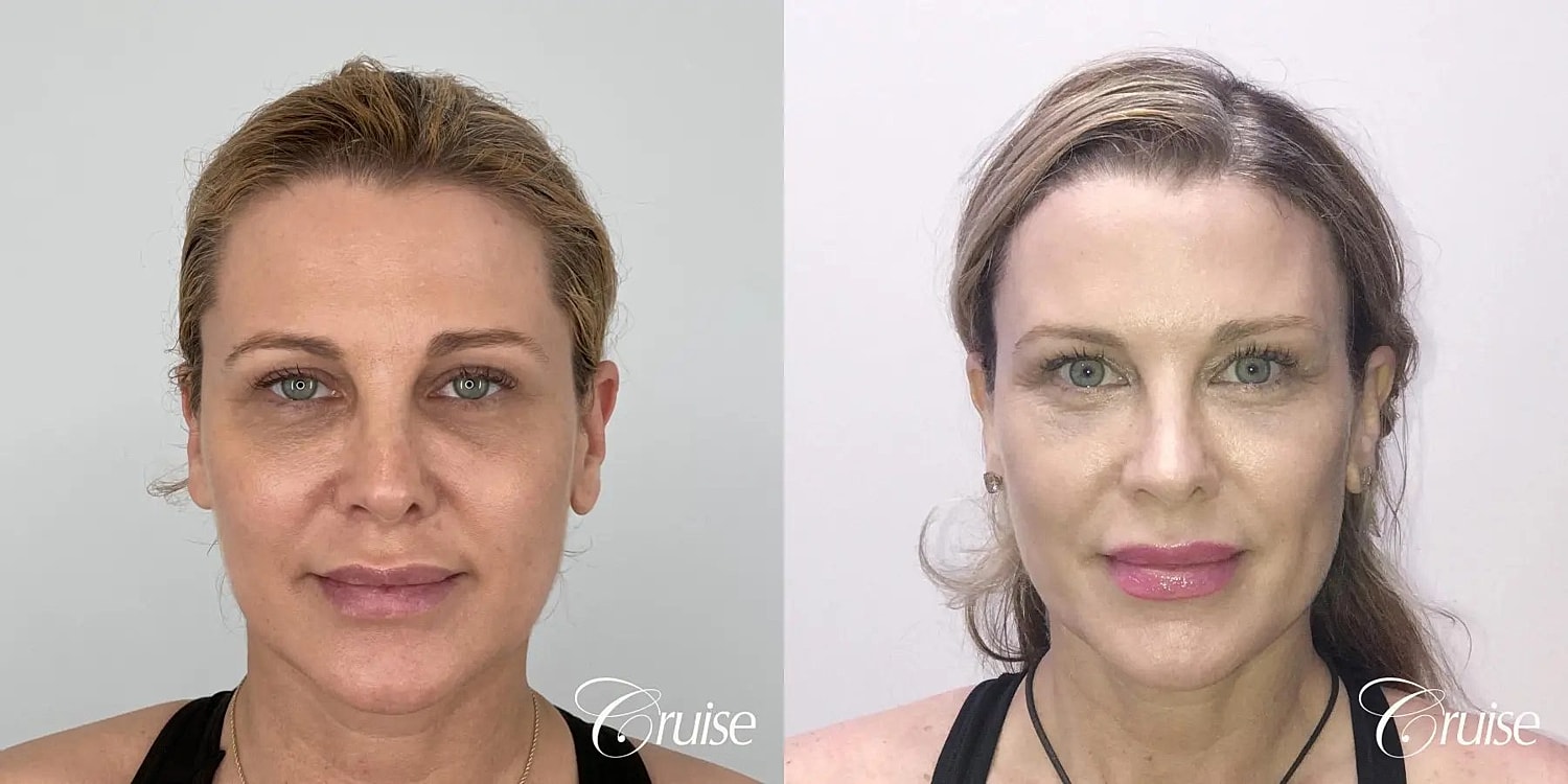 Brow Lift Before & After