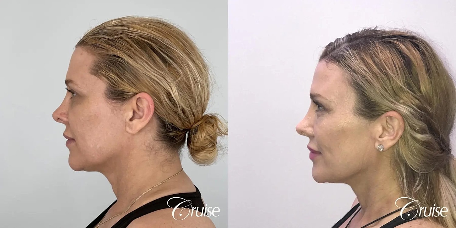 Brow Lift Before & After