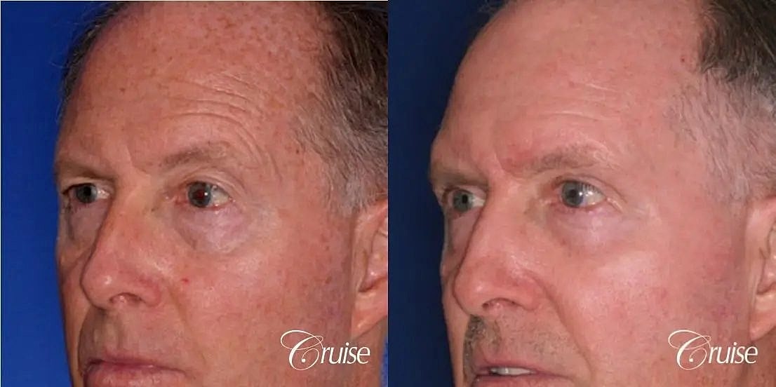 Chemical Peel Before & After