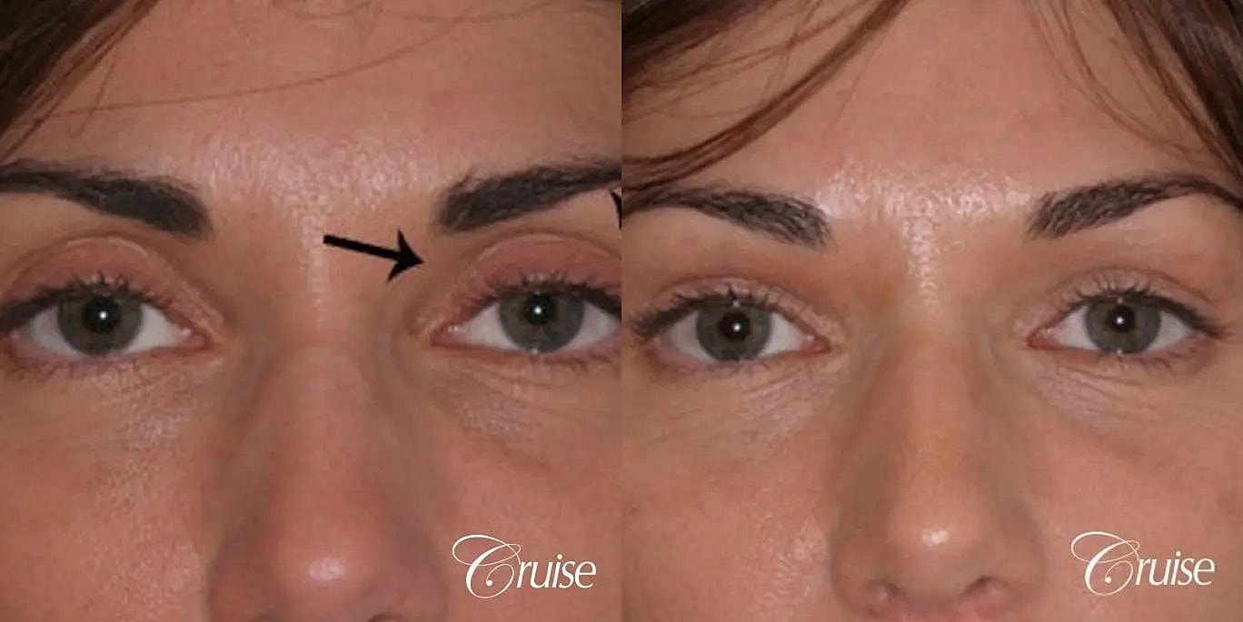 Dermal Fillers Before & After