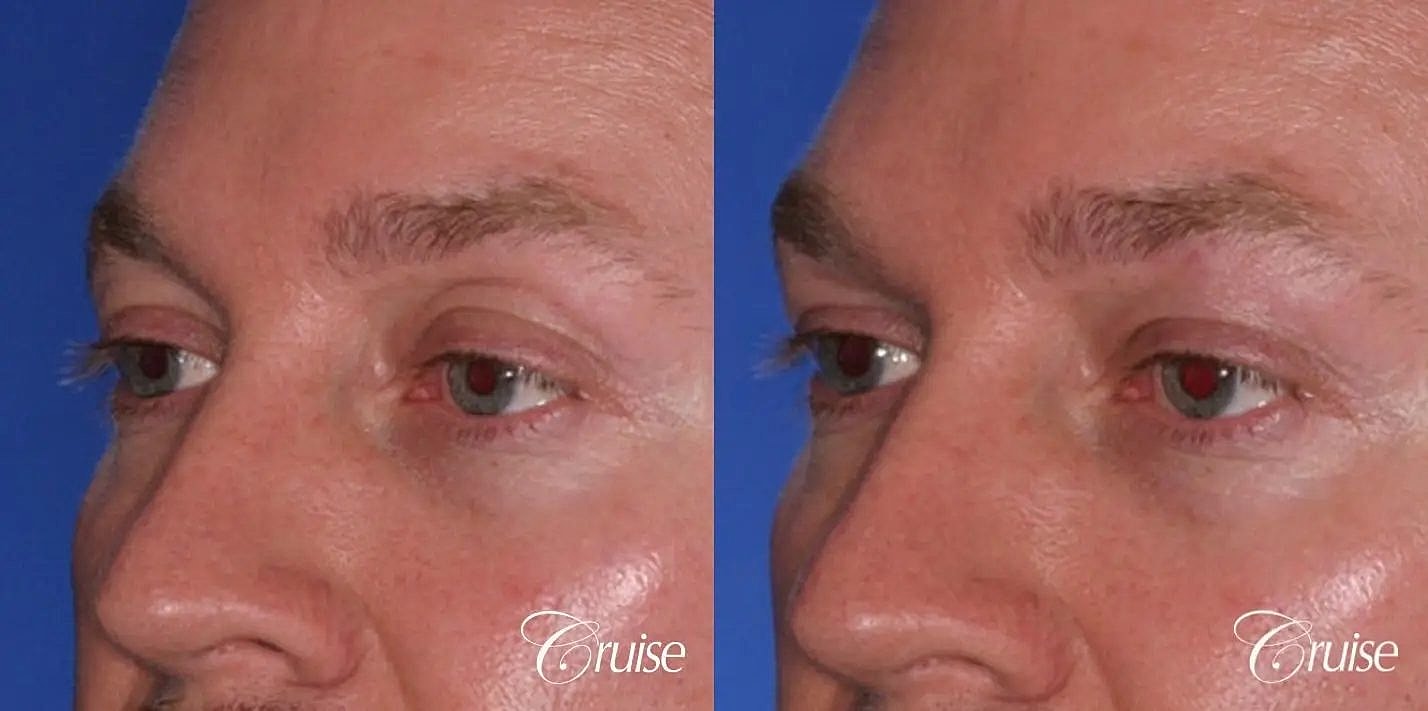 Dermal Fillers Before & After