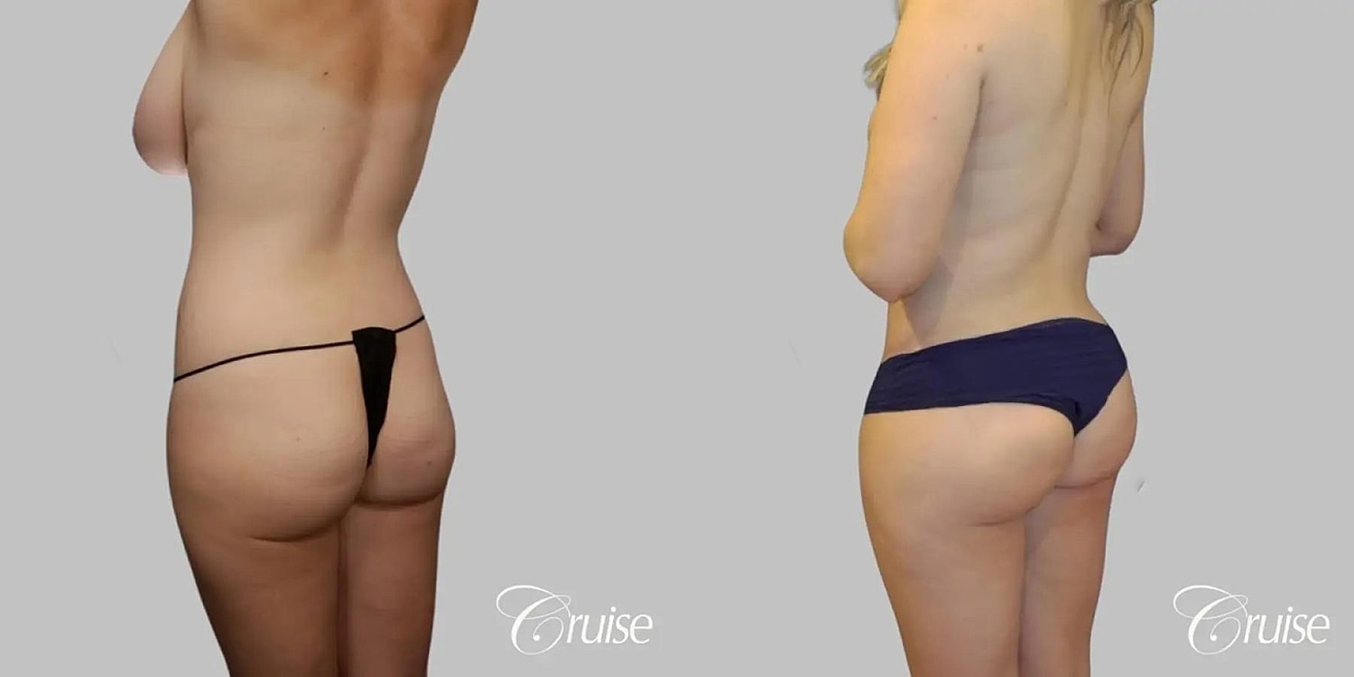 Brazilian Butt Lift Before & After