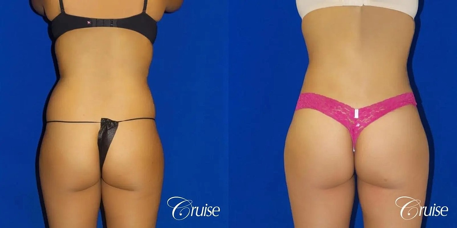Brazilian Butt Lift Before & After