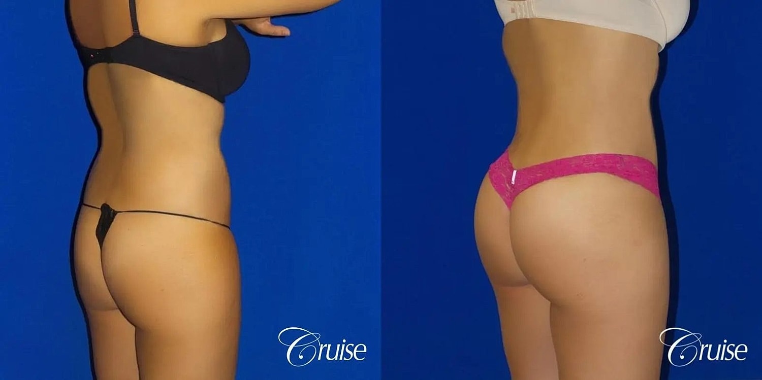 Brazilian Butt Lift Before & After