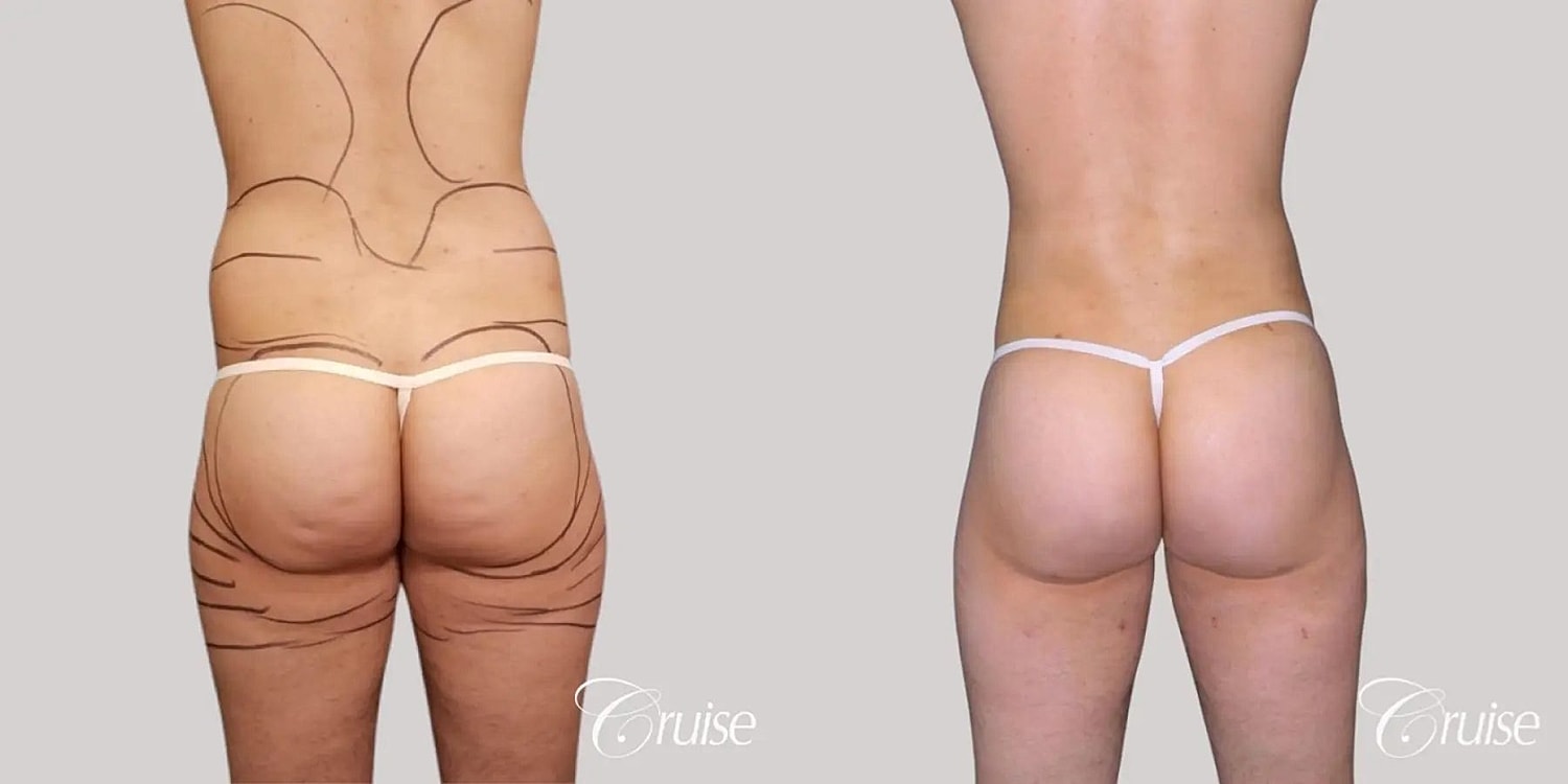 Brazilian Butt Lift Before & After