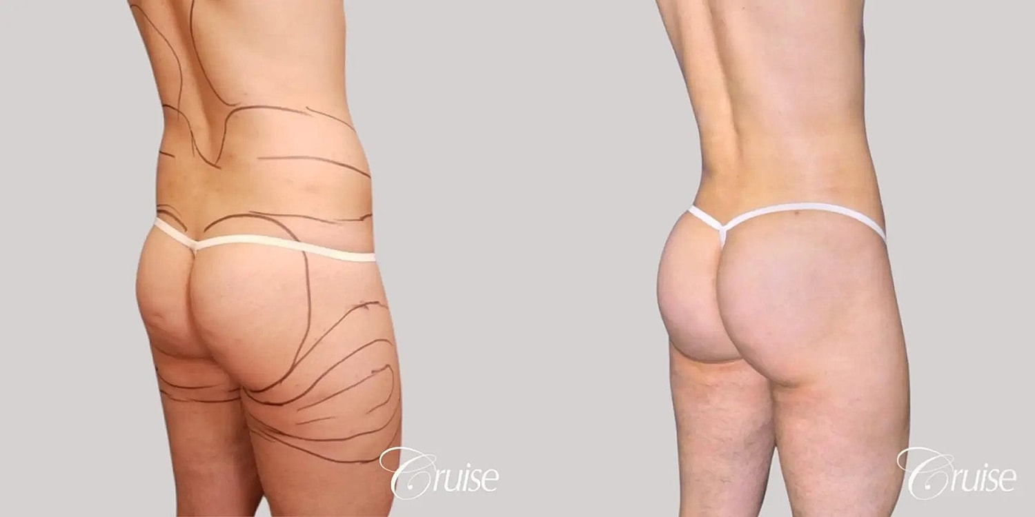 Brazilian Butt Lift Before & After