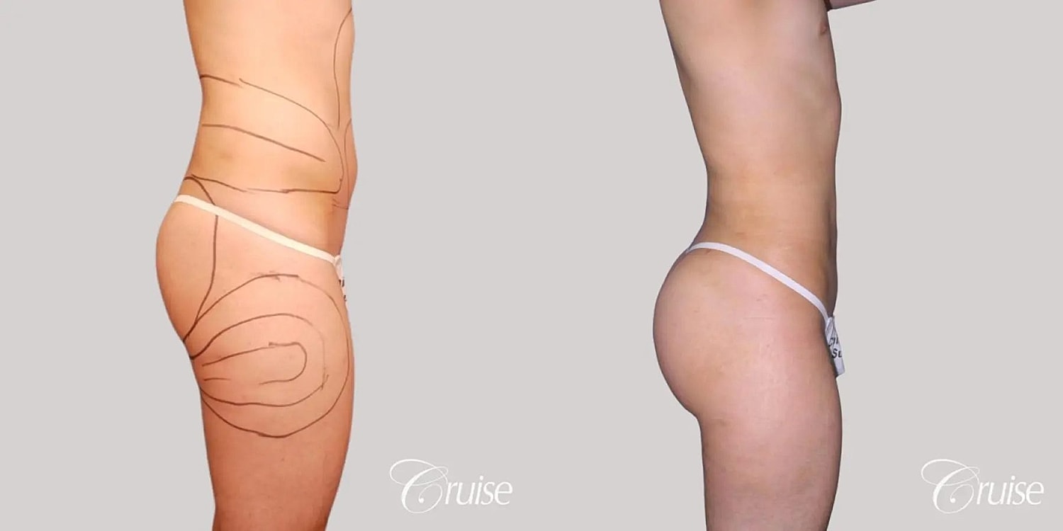 Brazilian Butt Lift Before & After