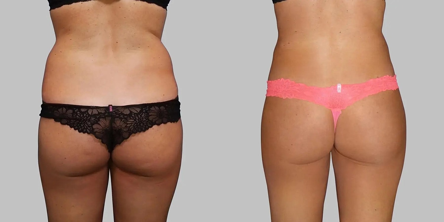 Brazilian Butt Lift Before & After