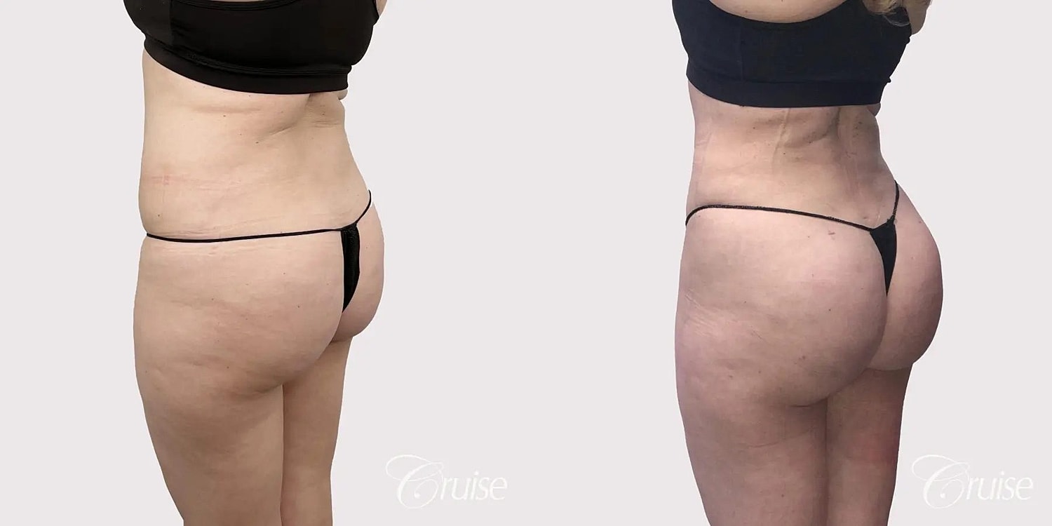 Brazilian Butt Lift Before & After