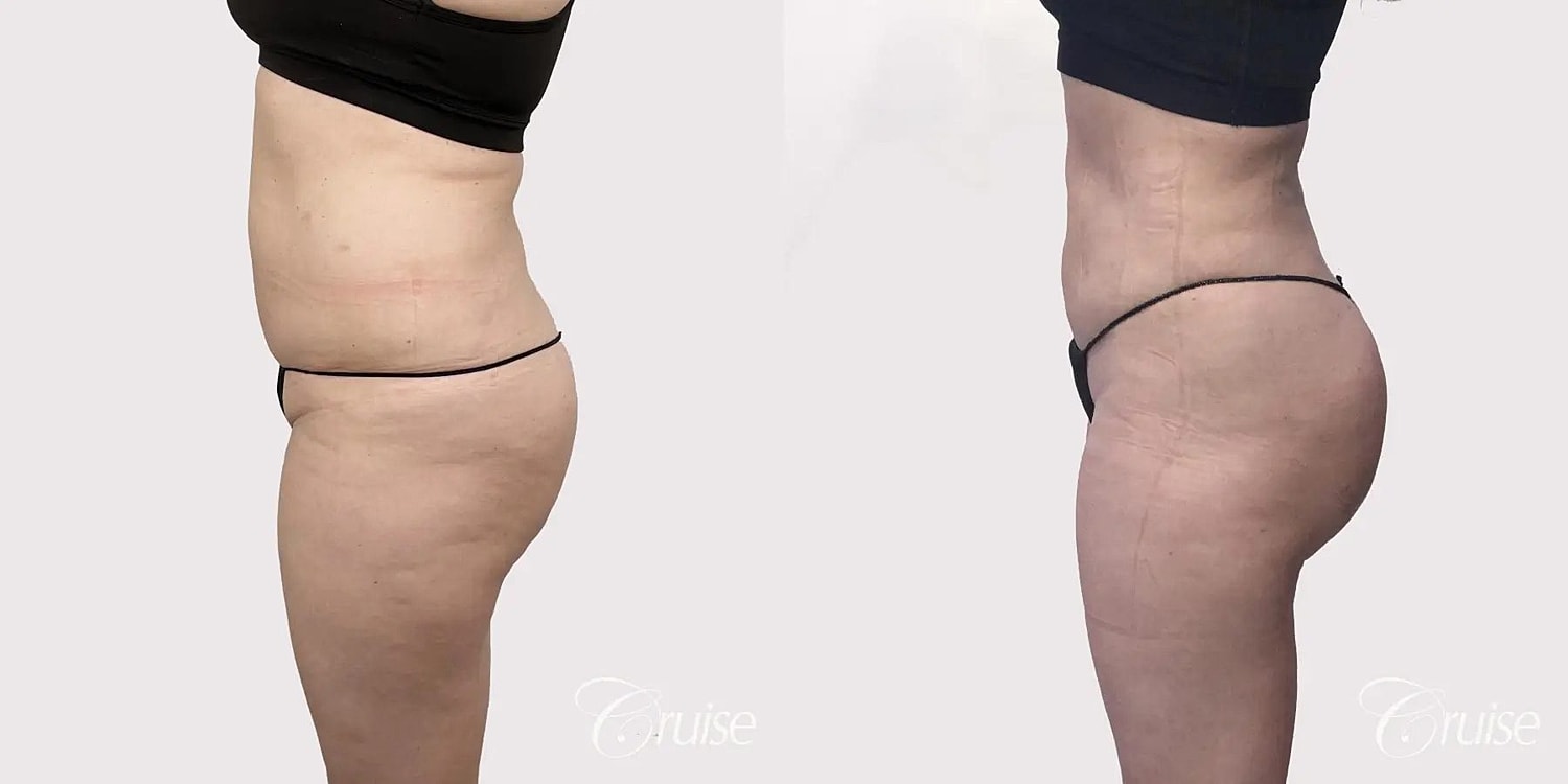 Brazilian Butt Lift Before & After