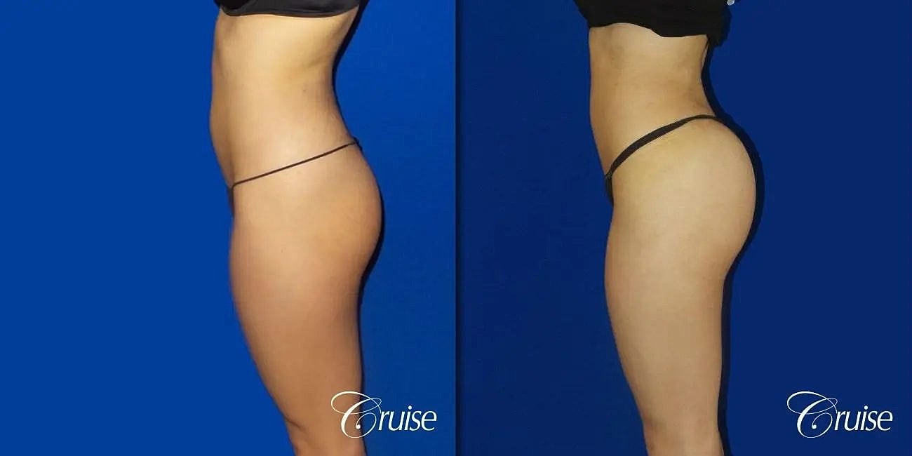 Brazilian Butt Lift Before & After