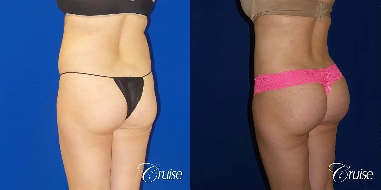 Brazilian Butt Lift Before & After