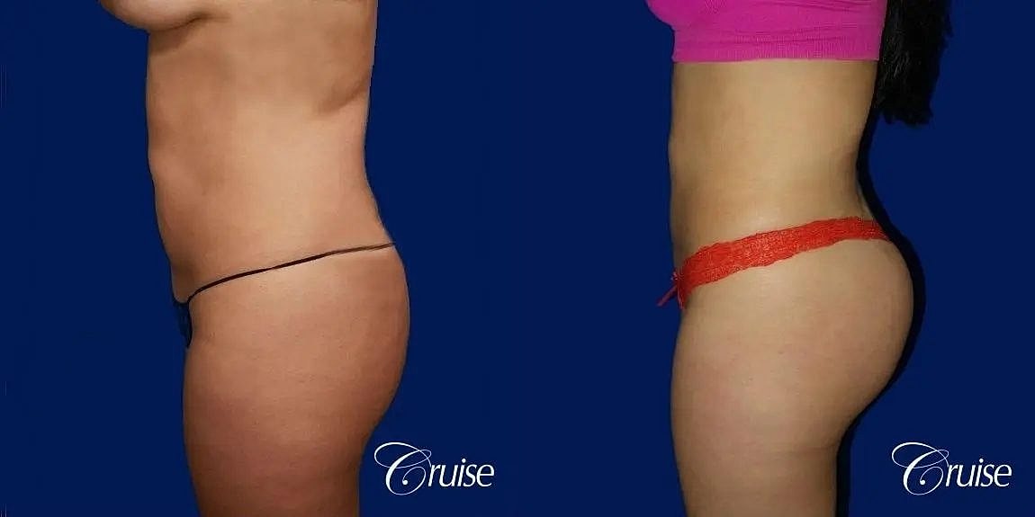 Brazilian Butt Lift Before & After