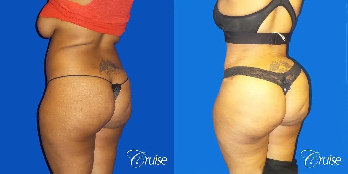 Brazilian Butt Lift Before & After