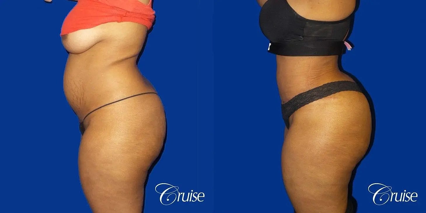 Brazilian Butt Lift Before & After