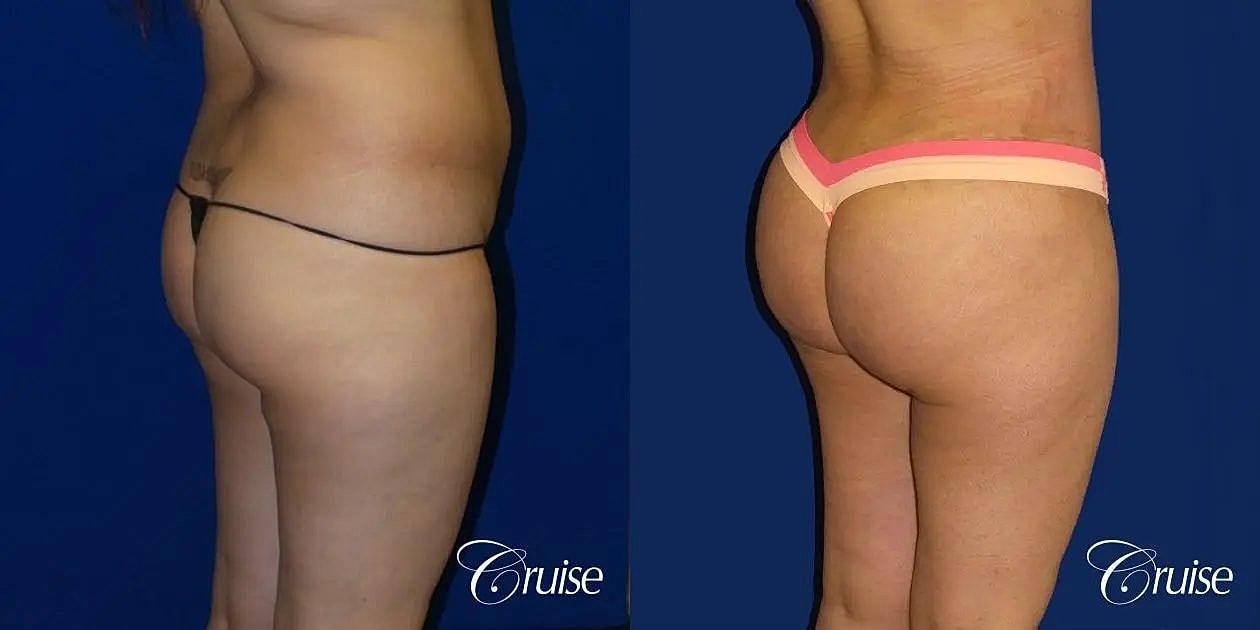 Brazilian Butt Lift Before & After