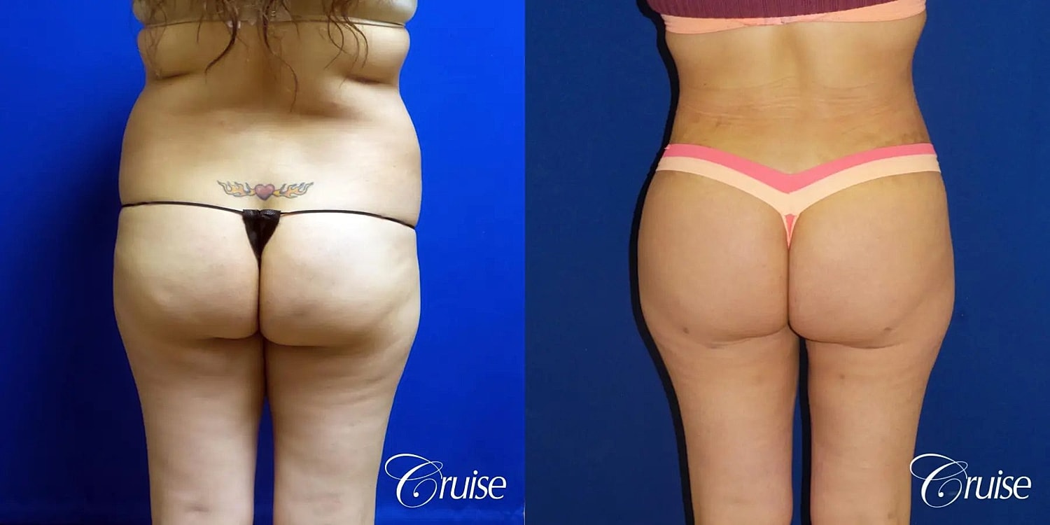 Brazilian Butt Lift Before & After