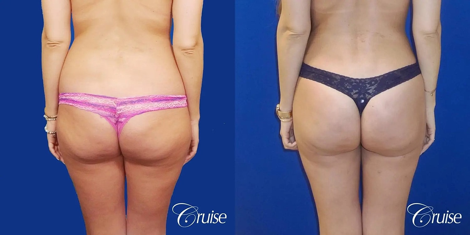 Brazilian Butt Lift Before & After