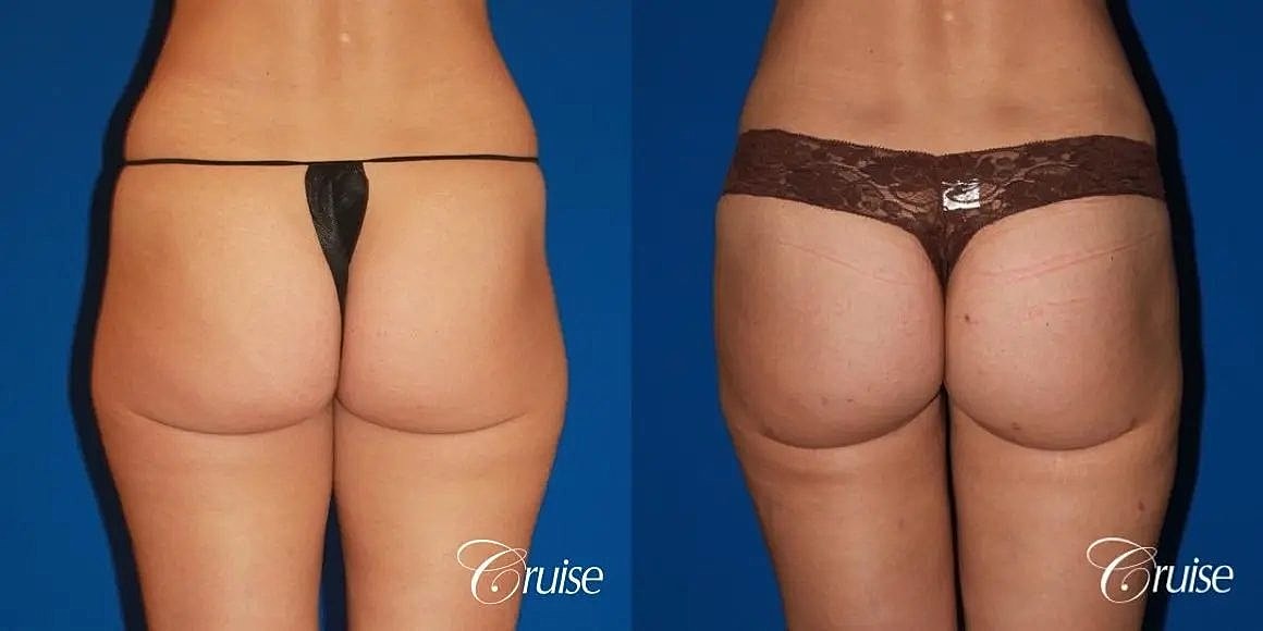 Brazilian Butt Lift Before & After