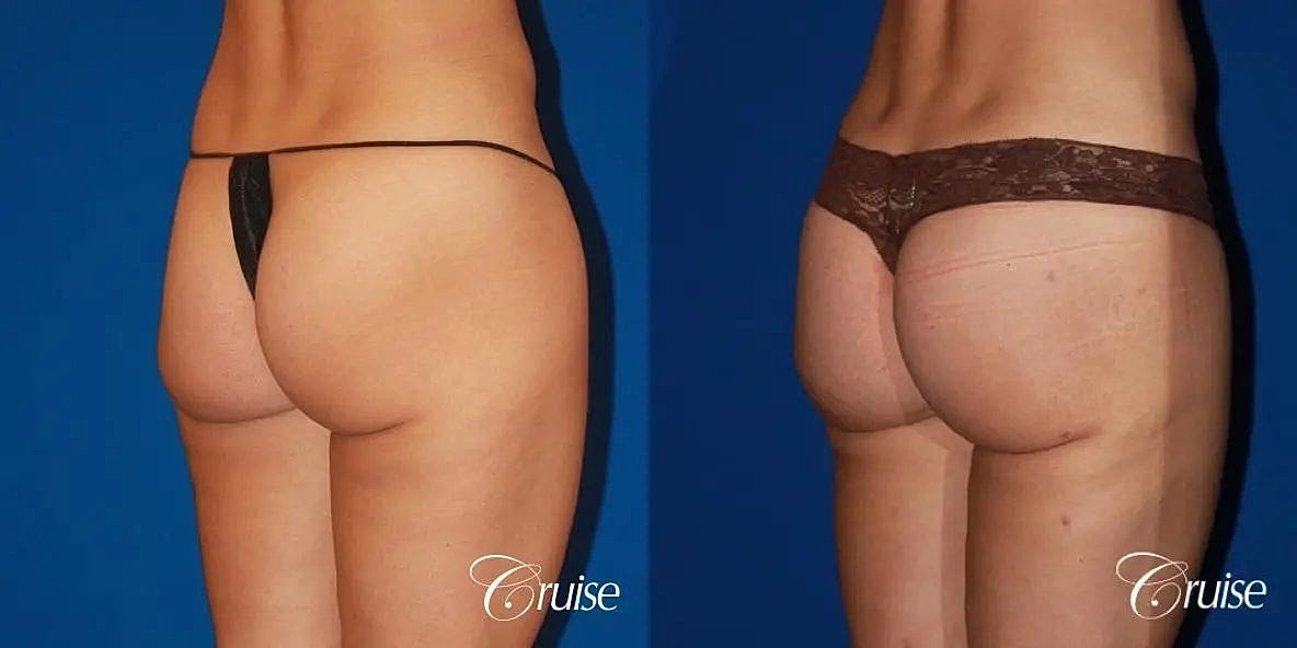 Brazilian Butt Lift Before & After