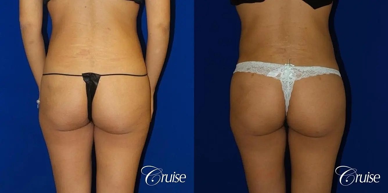Brazilian Butt Lift Before & After