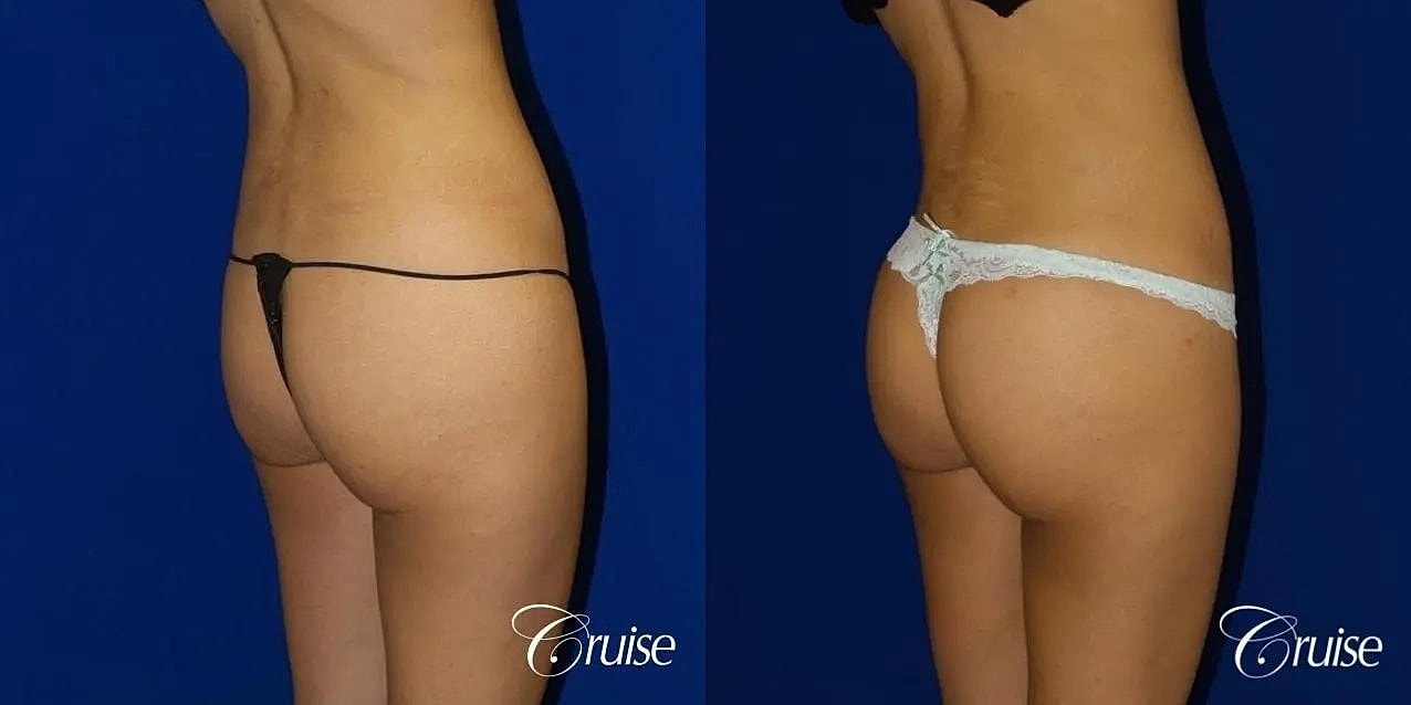 Brazilian Butt Lift Before & After