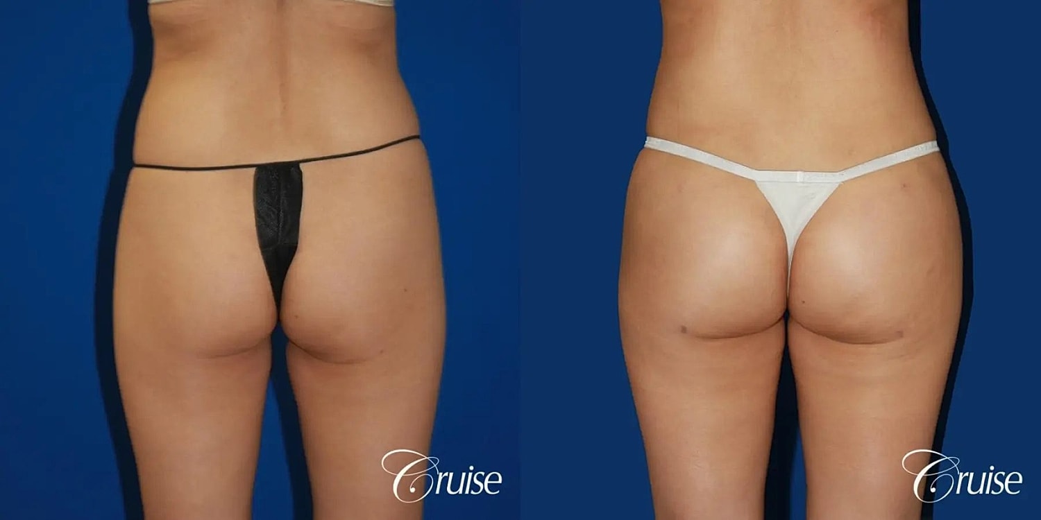 Brazilian Butt Lift Before & After