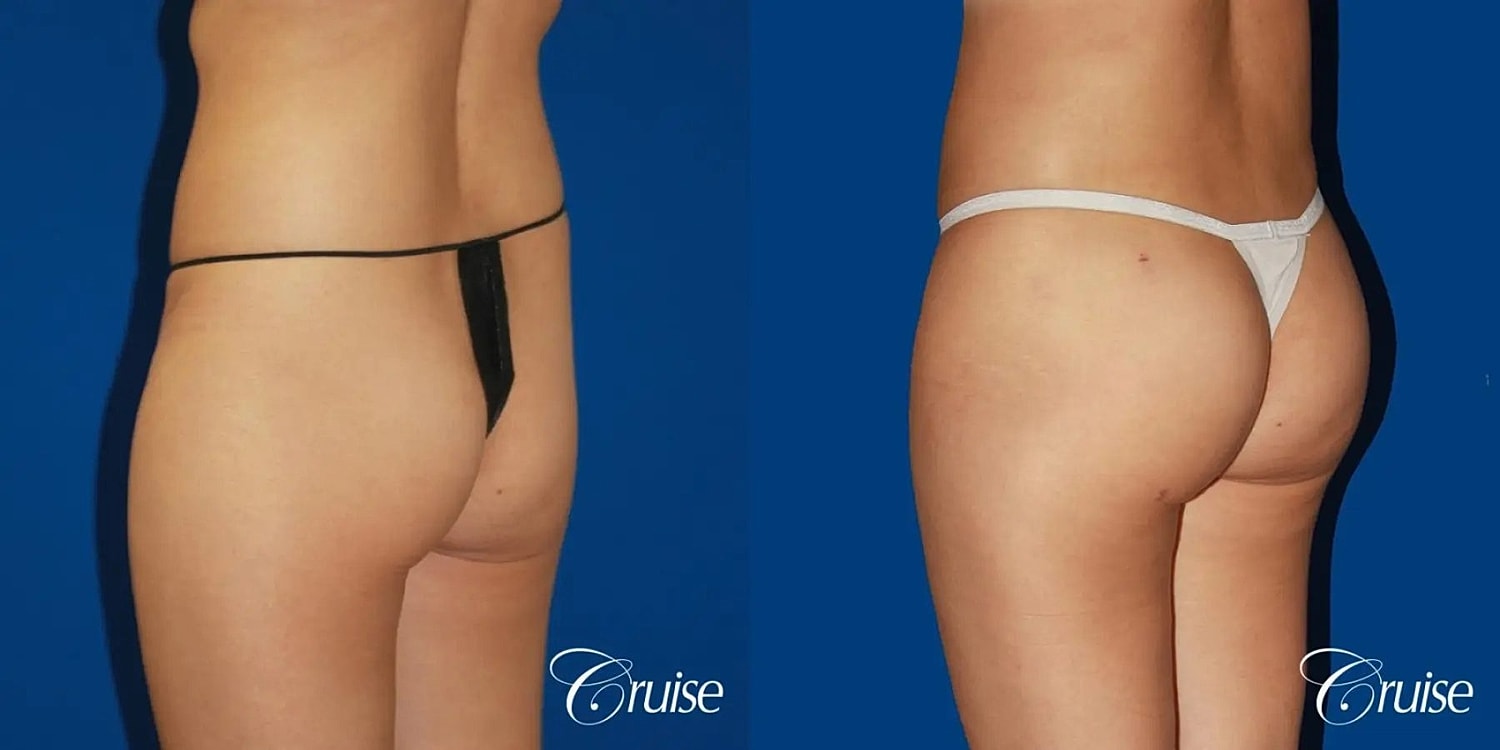 Brazilian Butt Lift Before & After
