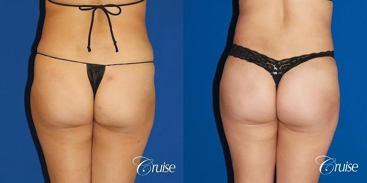 Brazilian Butt Lift Before & After