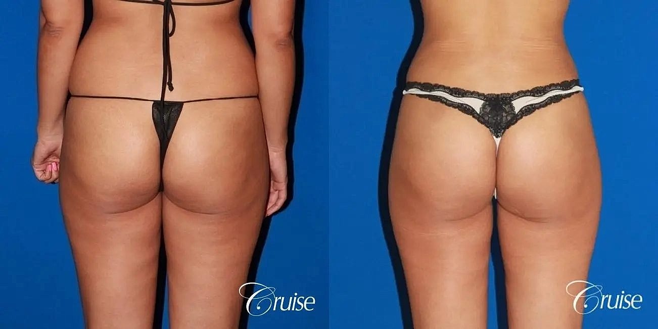 Brazilian Butt Lift Before & After