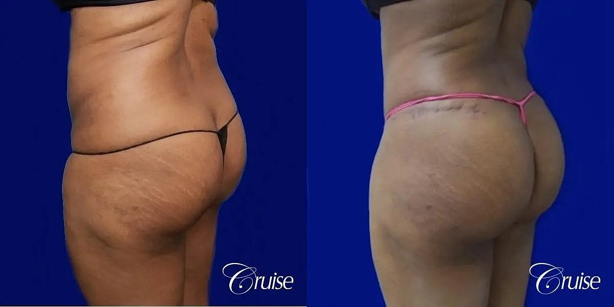 Brazilian Butt Lift Before & After