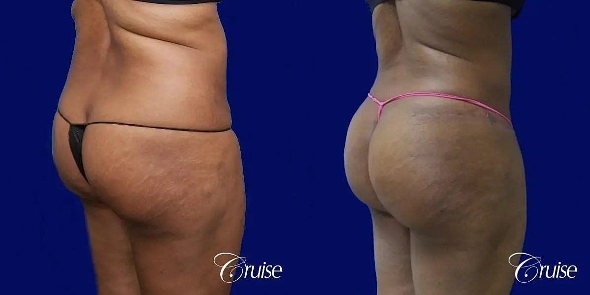 Brazilian Butt Lift Before & After