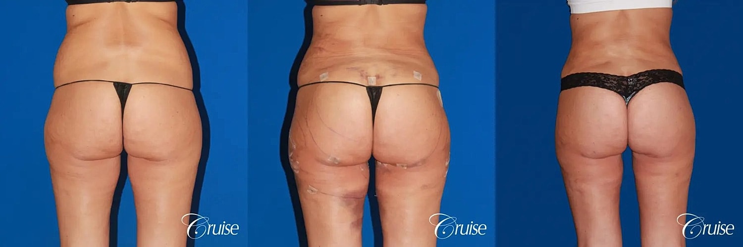 Brazilian Butt Lift Before & After