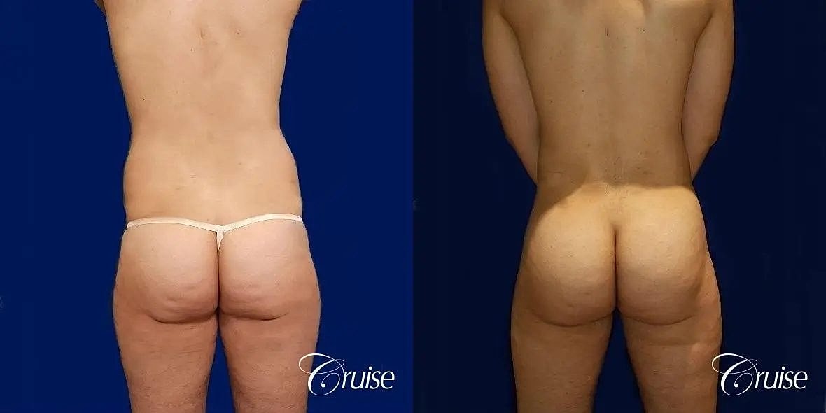 Brazilian Butt Lift Before & After