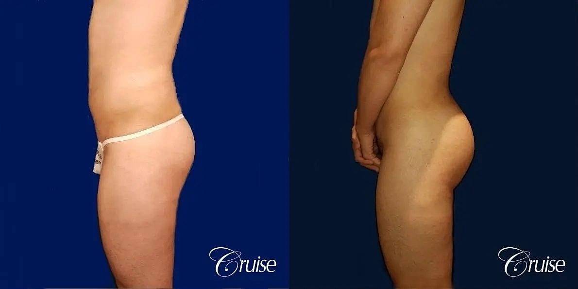 Brazilian Butt Lift Before & After