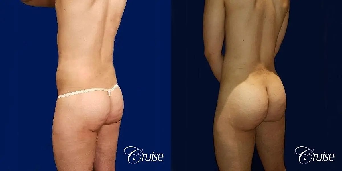 Brazilian Butt Lift Before & After