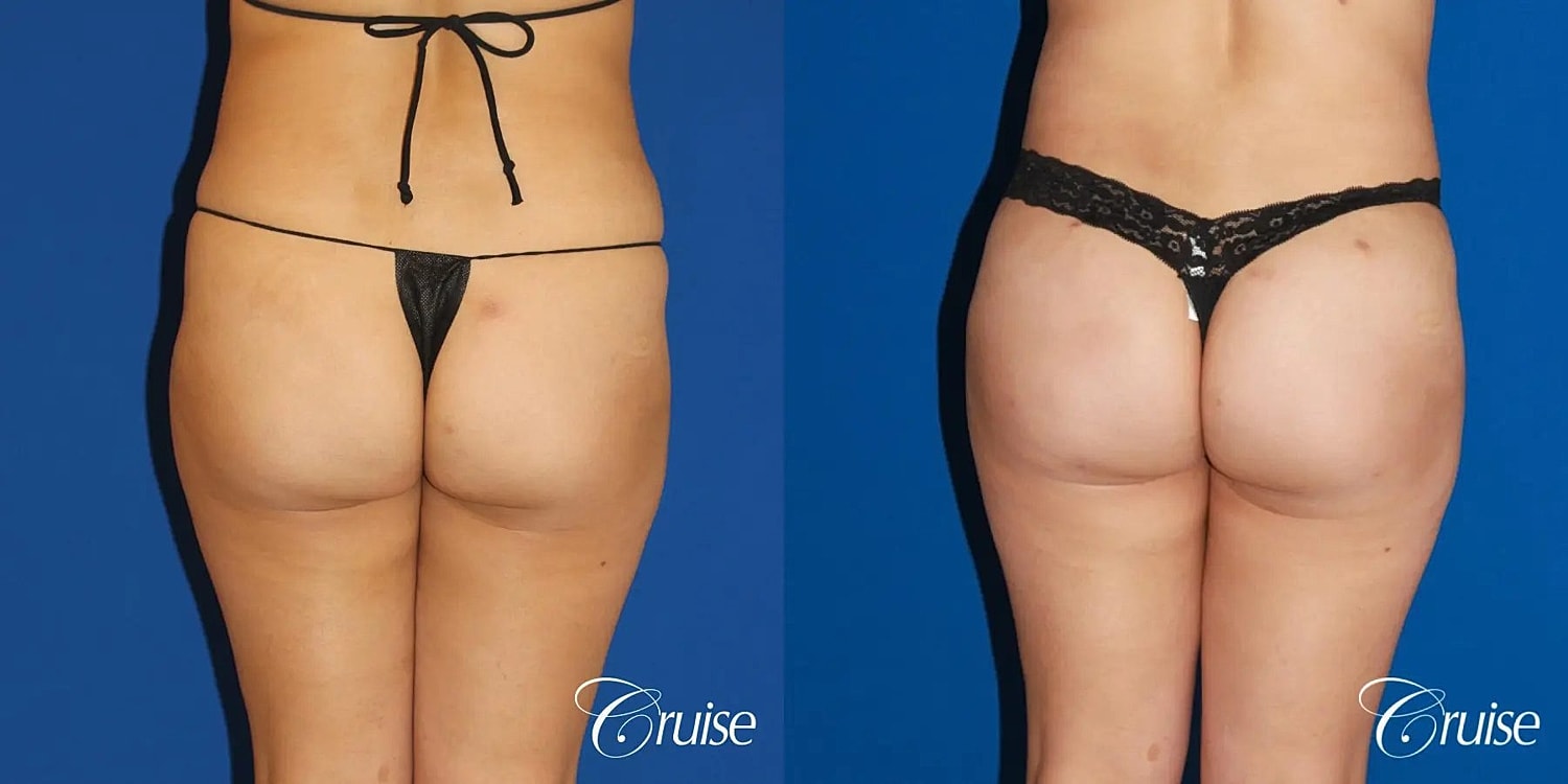 Brazilian Butt Lift Before & After