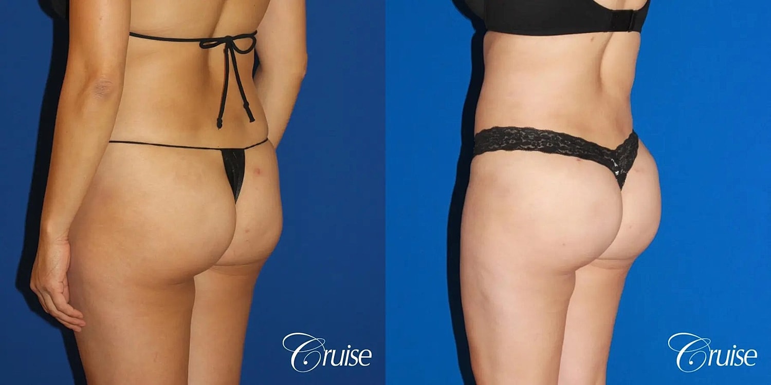 Brazilian Butt Lift Before & After