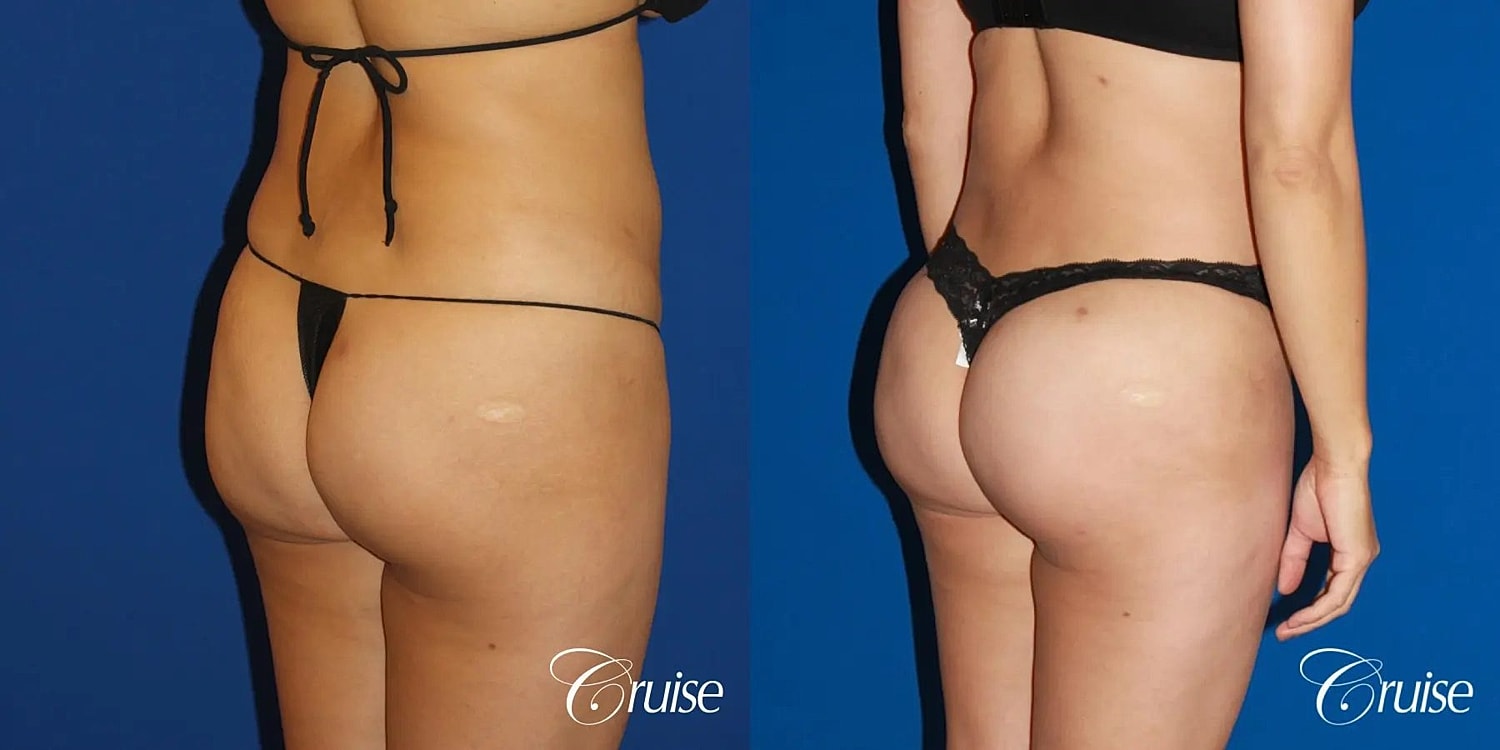 Brazilian Butt Lift Before & After