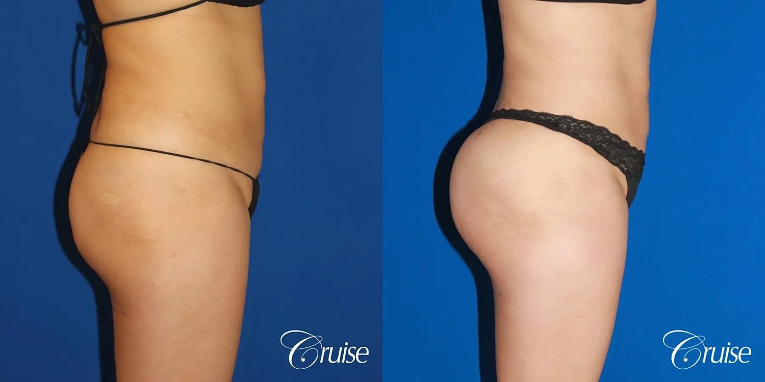 Brazilian Butt Lift Before & After